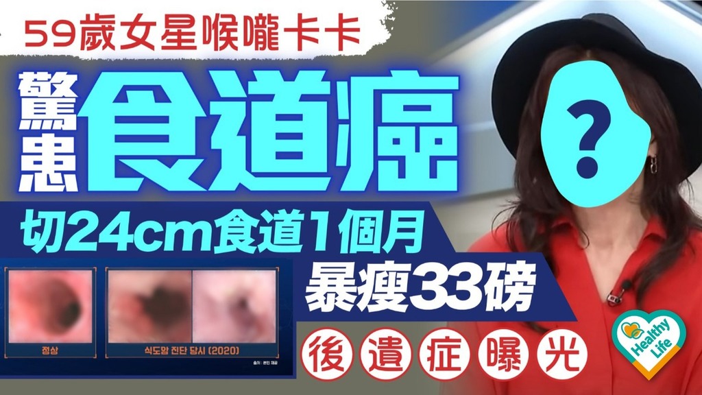 食道癌｜59歲女星喉嚨卡卡驚患食道癌 切24cm食道1個月暴瘦33磅 後遺症曝光