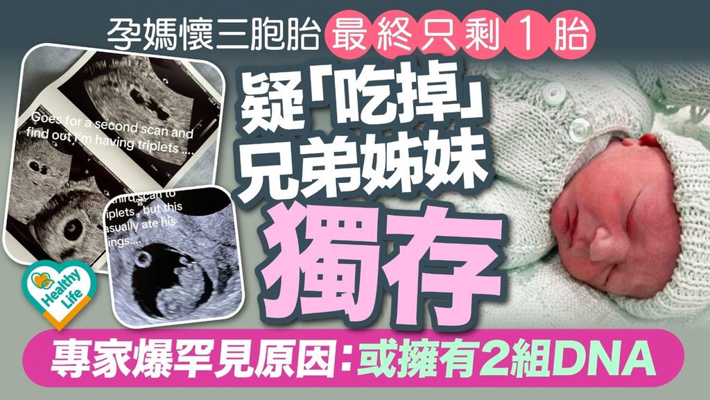 胚胎融合︱孕媽懷三胞胎最終只剩1胎疑「吃掉」兄弟姊妹獨存 專家爆罕見原因：或擁有2組DNA