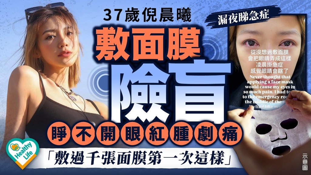 眼睛健康｜37歲倪晨曦敷面膜險盲 雙眼睜不開紅腫兼劇痛 漏夜睇急症【附異物入眼正確處理方法】