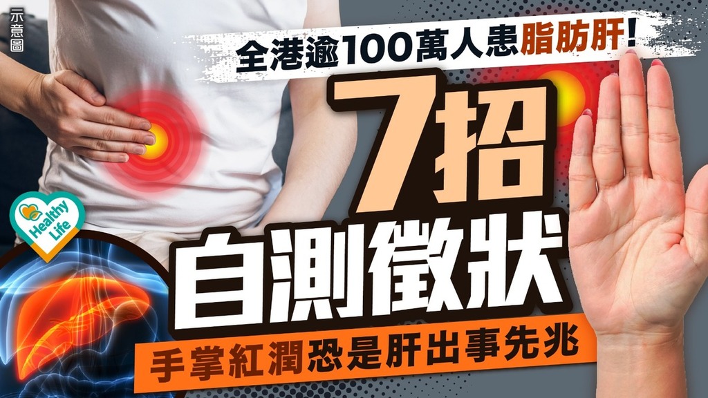脂肪肝自測︱全港逾100萬人患脂肪肝 7招自測徵狀：手掌紅潤恐是肝出事先兆