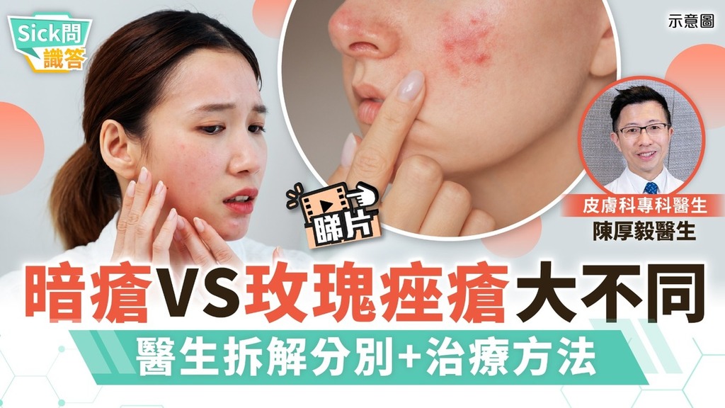 Sick問識答｜暗瘡VS玫瑰痤瘡大不同 醫生拆解兩者分別+治療方法
