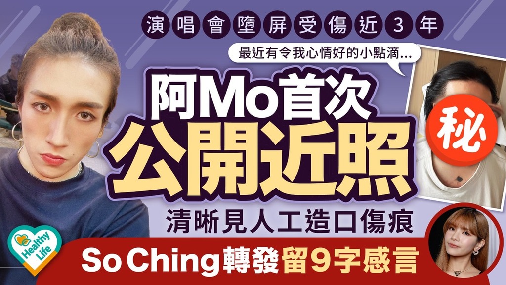 阿MO進度丨墮屏意外近3年阿Mo首次公開近照可見人工造口傷痕 So Ching轉發留9字感言 