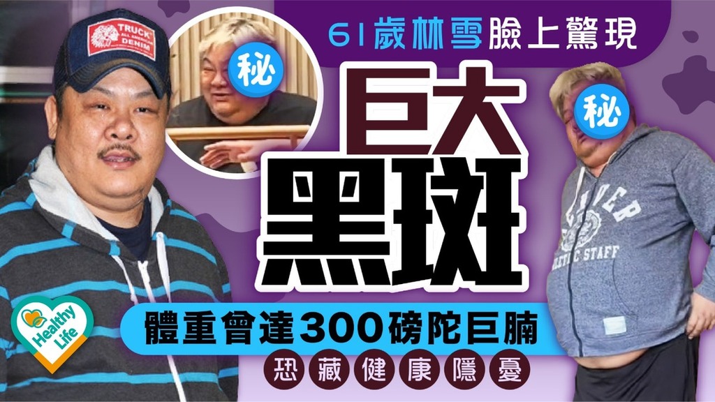 明星健康︱61歲林雪臉上驚現巨大黑斑 體重曾達300磅陀巨腩恐藏健康隱憂