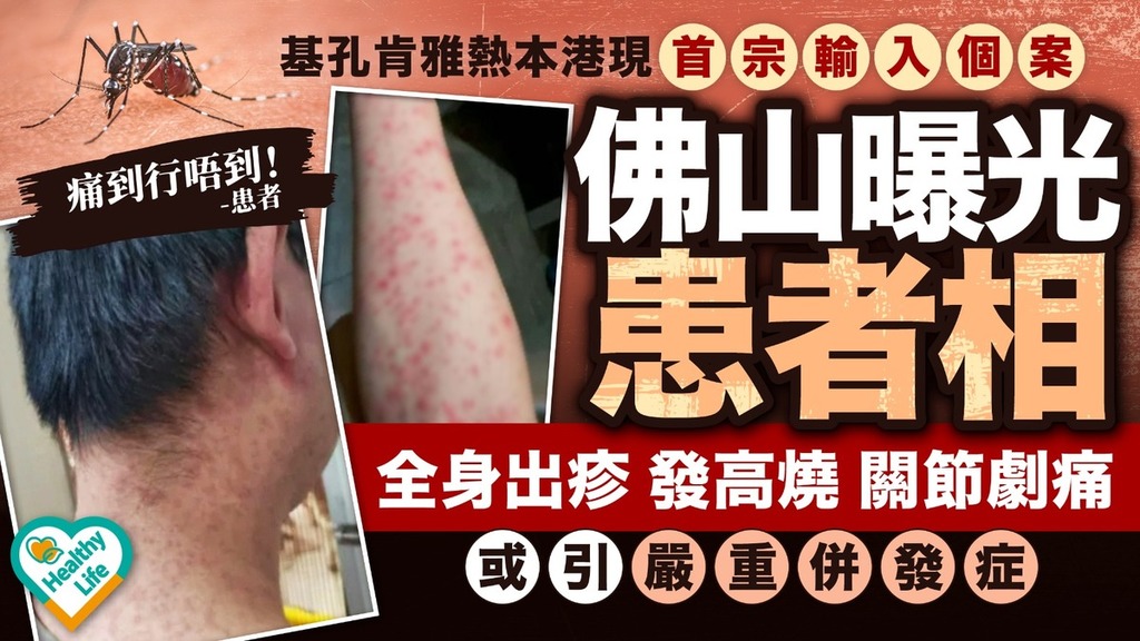 基孔肯雅熱丨基孔肯雅熱本港現首宗輸入個案 佛山曝光患者相 全身出疹、發高燒、關節劇痛或引嚴重併發症