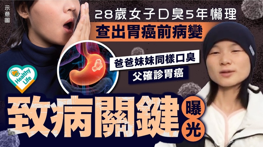胃癌｜28歲女子懶理口臭5年檢查發現「胃癌前病變」 致病關鍵曝光