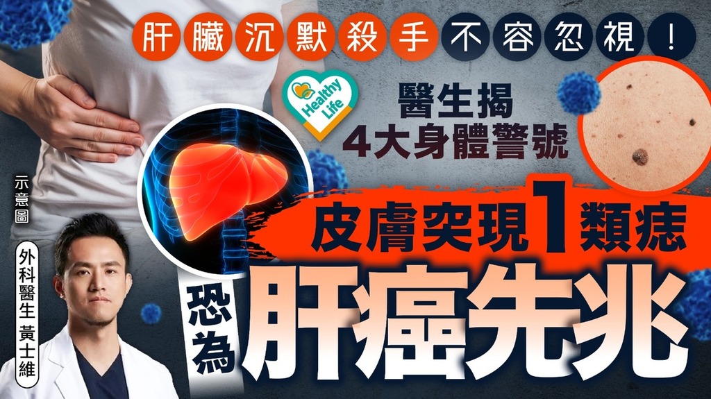 肝癌警號｜肝臟沉默殺手不容忽視 醫生揭4大身體警號 皮膚突現1類痣恐為肝癌先兆