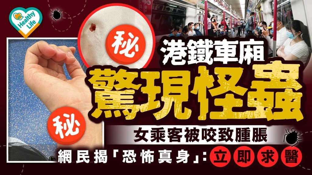 蟲出沒注意｜港鐵車廂驚現怪蟲女乘客被咬致腫脹 網民揭「恐怖真身」：立即求醫 【附港鐵回應】