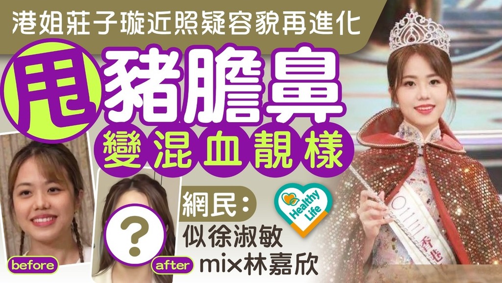 容貌進化︱港姐莊子璇近照疑容貌再進化 甩豬膽鼻變混血靚樣：似徐淑敏mix林嘉欣