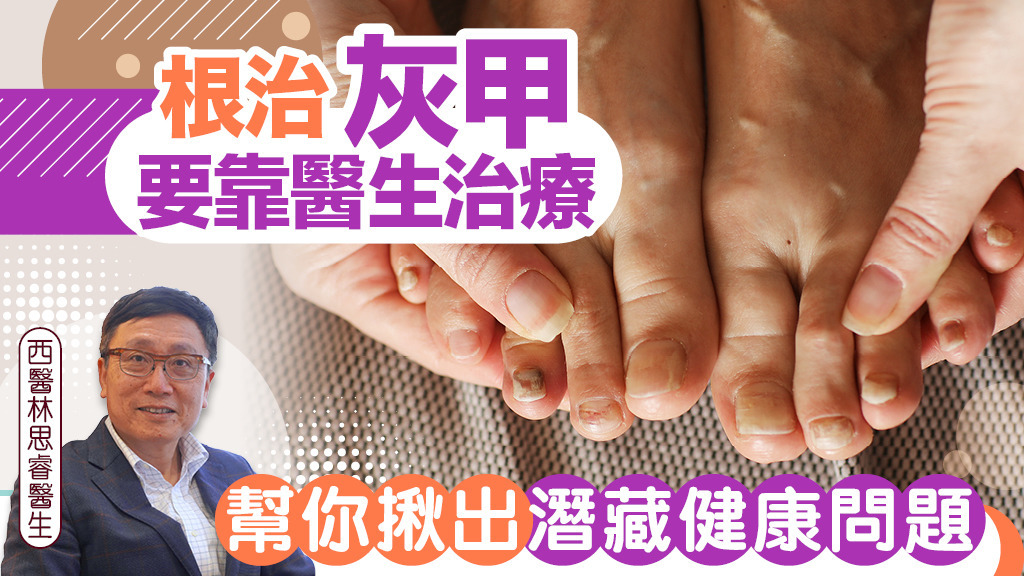 根治灰甲要靠醫生治療 幫你揪出潛藏健康問題