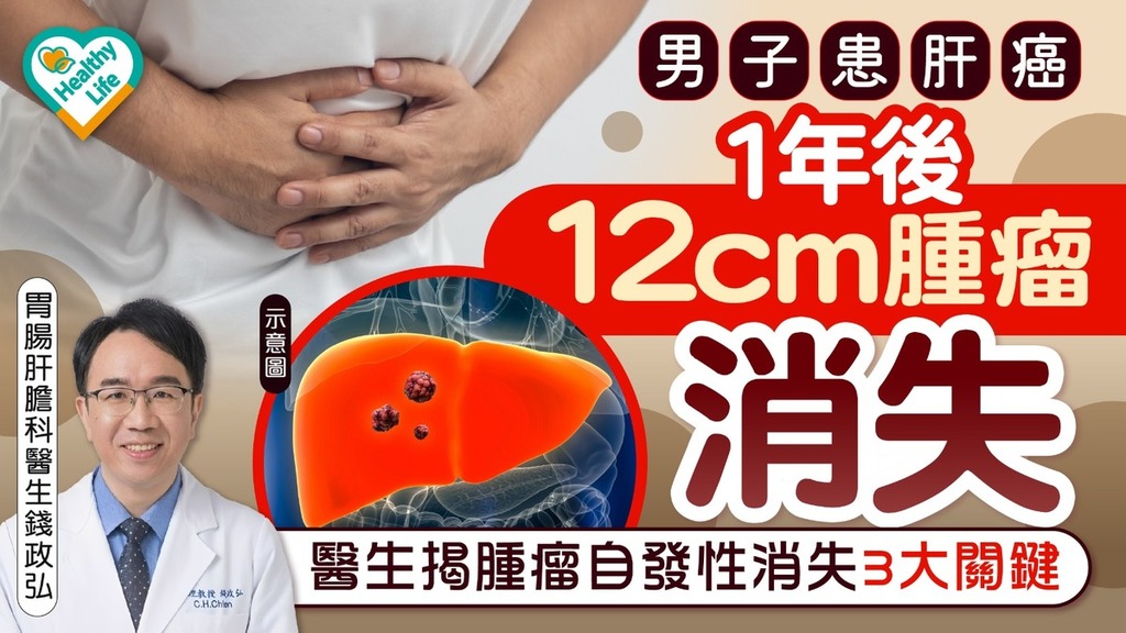 男子患肝癌1年後12cm腫瘤消失 醫生揭腫瘤自發性消失3大關鍵