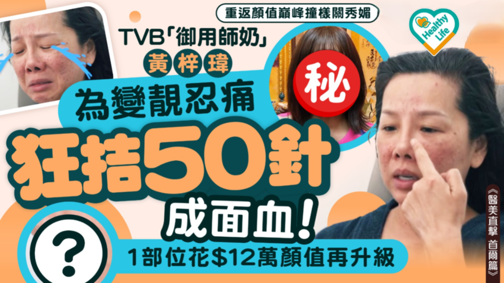 醫美直擊｜TVB「御用師奶」黃梓瑋為變靚 忍痛狂拮50針成面血 1部位花$12萬顏值再升級