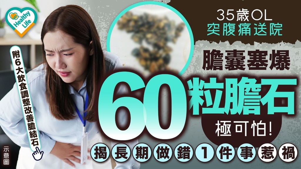 膽結石｜35歲OL突腹痛送院 膽囊塞爆60粒膽石極可怕 揭長期做錯1件事惹禍