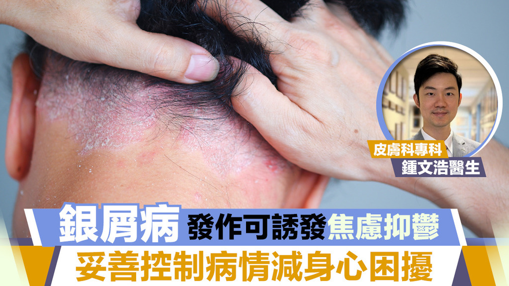 銀屑病發作可誘發焦慮抑鬱 妥善控制病情減身心困擾 