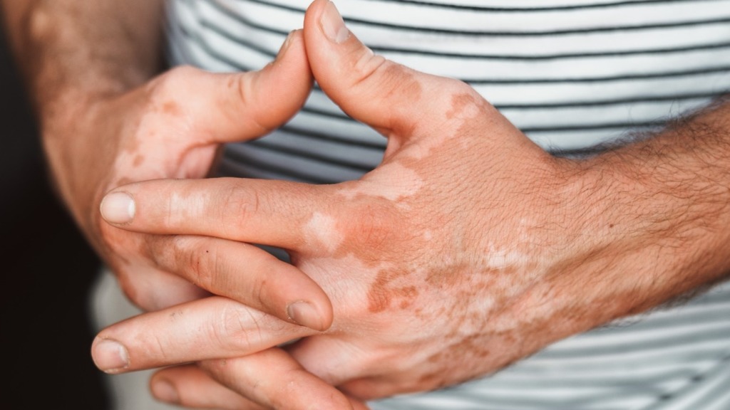 白蝕治療︱白蝕不會自行治癒 醫生籲早診早治 及早用藥有助患者復色