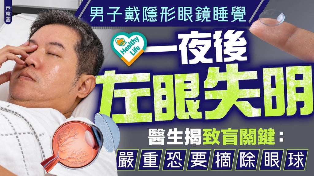 眼睛健康｜男子戴隱形眼鏡睡覺一夜後左眼失明 醫生揭致盲關鍵：嚴重恐要摘除眼球