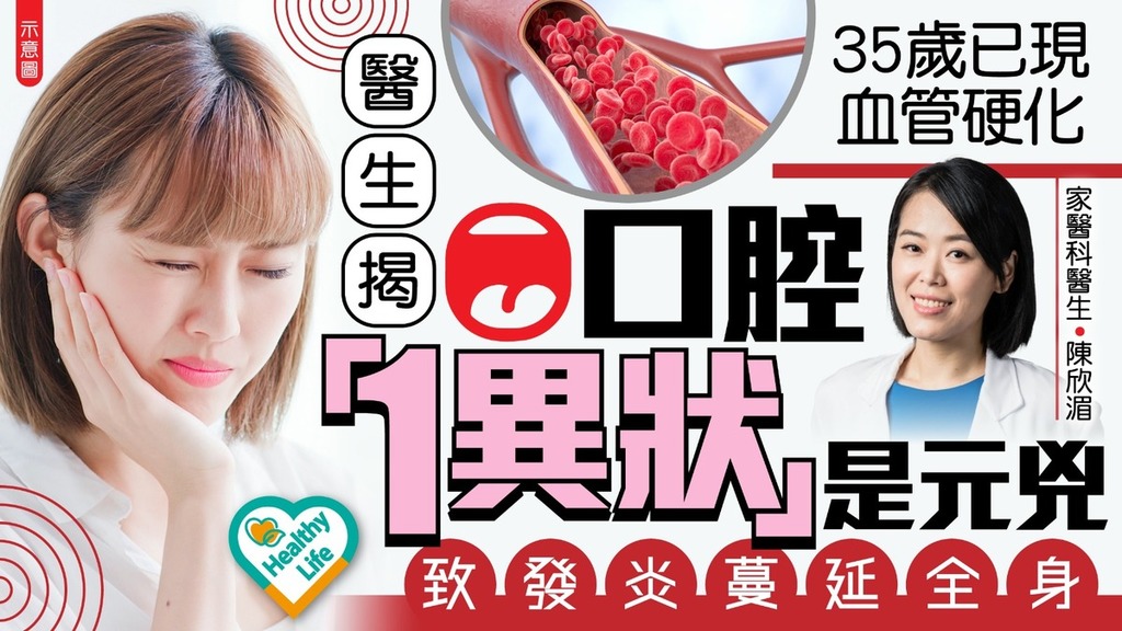 心血管健康｜35歲已現血管硬化 醫生揭口腔「1異狀」是元兇 致發炎蔓延全身