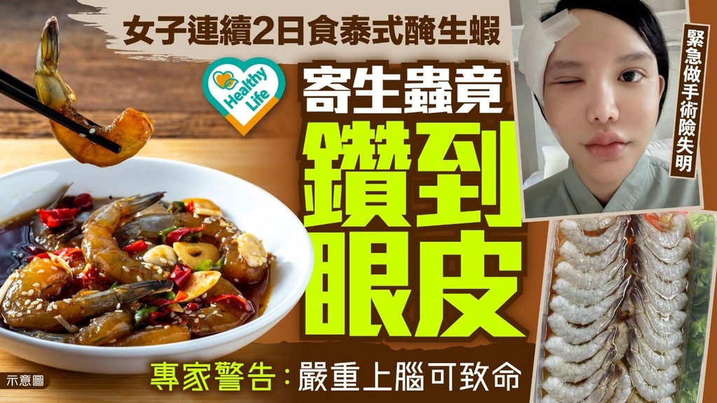 寄生蟲｜女子連續2日食泰式醃生蝦 寄生蟲竟鑽到眼皮 專家警告：嚴重上腦可致命