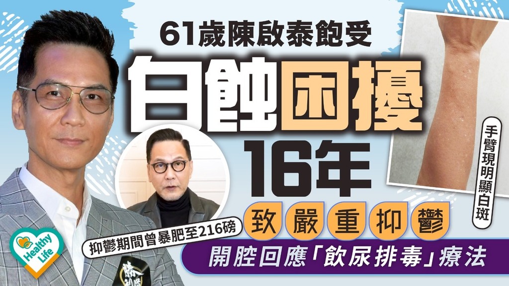 陳啟泰丨61歲陳啟泰飽受白蝕困擾16年 致嚴重抑鬱曾暴肥至216磅 開腔回應「飲尿排毒」療法