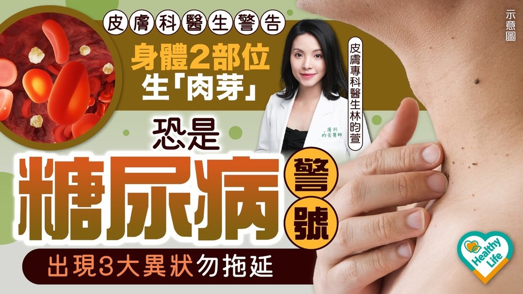 糖尿病｜身體2大部位生「肉芽」恐是糖尿病警號 皮膚科醫生：出現3大異狀勿拖延
