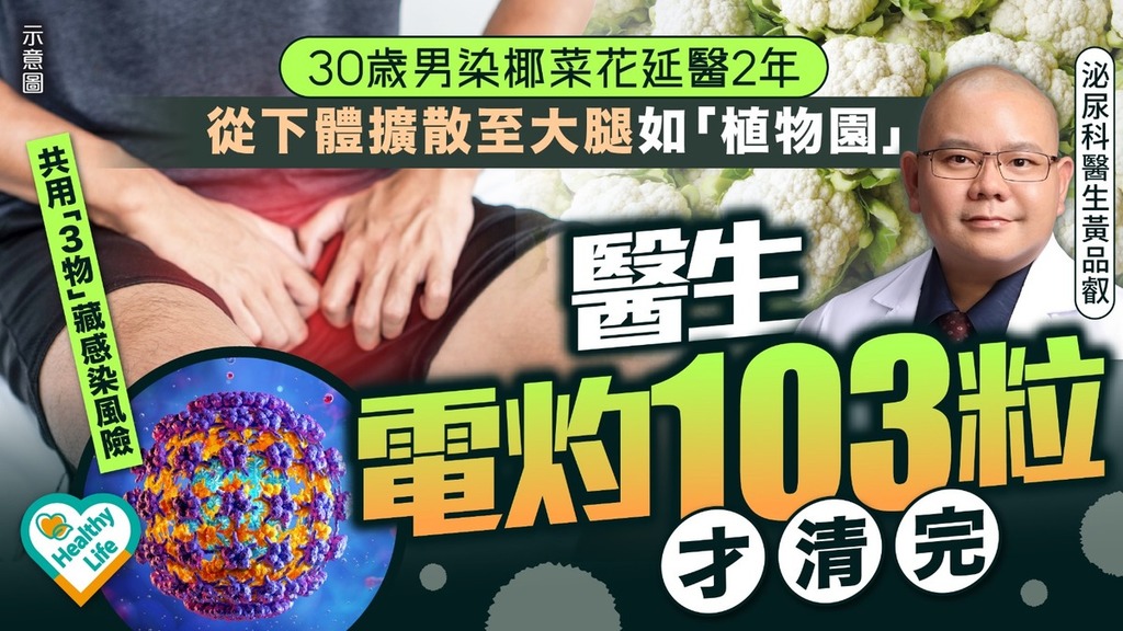 性病危機｜30歲男染椰菜花延醫2年 從下體擴散至大腿如「植物園」 醫生電灼103粒才清完