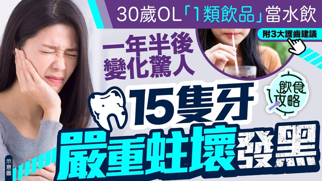 蛀牙危機｜30歲OL1類飲品當水飲 一年半15隻牙嚴重蛀壞發黑【附3大護齒建議】