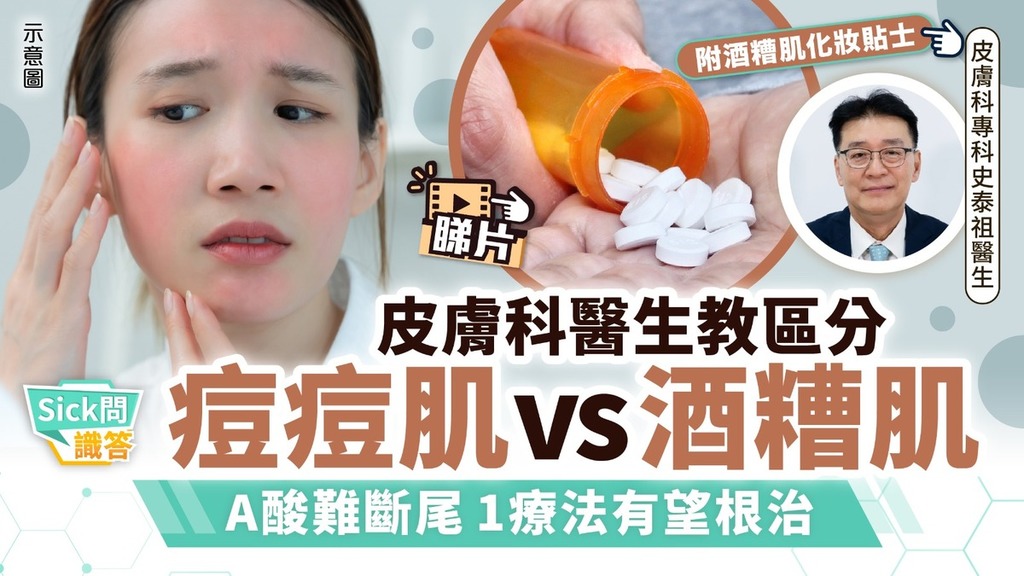 Sick問識答｜皮膚科醫生教區分痘痘肌vs酒糟肌 A酸難斷尾 1療法有望根治【附酒糟肌化妝貼士】