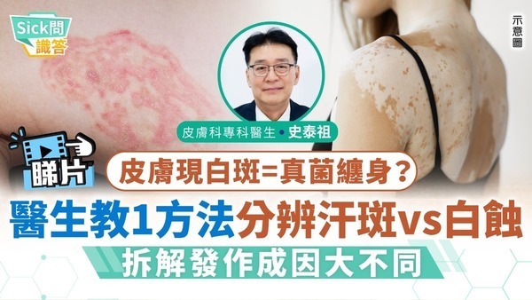 Sick問識答｜皮膚現白斑=真菌纏身？ 醫生教1方法分辨汗斑vs白蝕 解析發作成因大不同