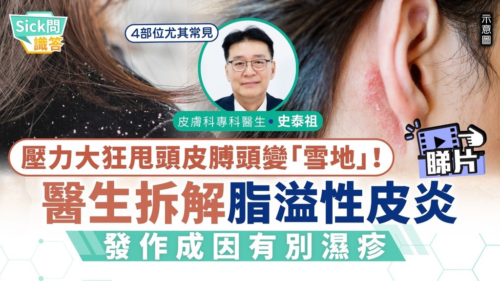 Sick問識答｜壓力大狂甩頭皮膊頭變「雪地」！ 醫生拆解脂溢性皮炎發作成因 有別濕疹4部位常見