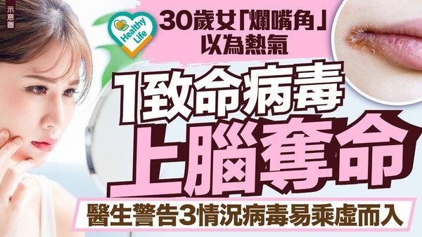 皰疹病毒︱30歲女「爛嘴角」以為熱氣 1致命病毒上腦奪命 醫生警告3情況病毒易乘虛而入 