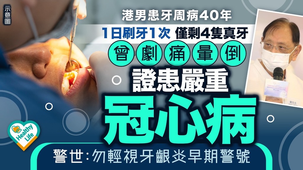 牙周病丨港男患牙周病40年1日刷牙1次僅剩4隻真牙 曾劇痛暈倒證患嚴重冠心病 警世：勿輕視牙齦炎早期警號