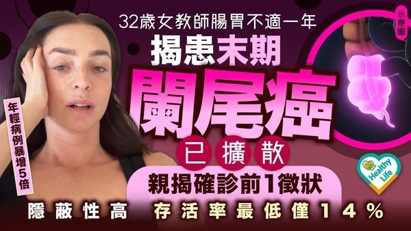 闌尾癌｜32歲女教師腸胃不適一年揭患末期闌尾癌已擴散 親揭確診前1徵狀 隱蔽性高存活率最低僅14%