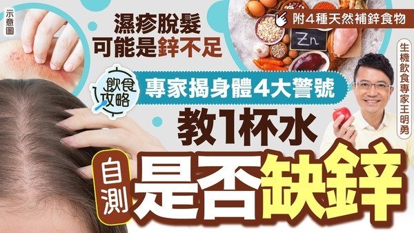 濕疹脫髮｜濕疹脫髮可能是鋅不足 專家揭身體4大警號 教1杯水自測是否缺鋅