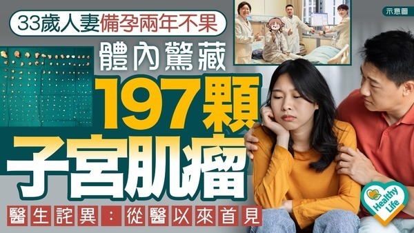 子宮肌瘤丨33歲女備孕兩年不果 體內驚藏197顆子宮肌瘤 醫生詫異：從醫以來首見【附子宮肌瘤4大症狀】 